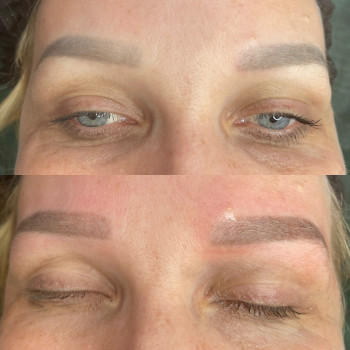 Брови до процедури та одразу після видалення ремувером