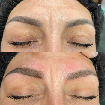 Брови до процедури та одразу після видалення ремувером