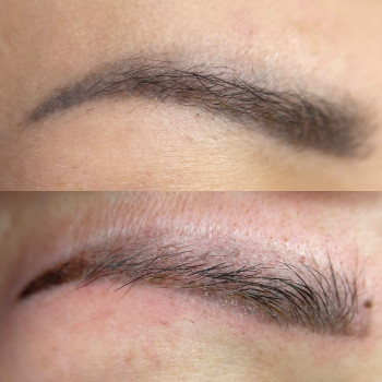 Брови до процедури та одразу після видалення ремувером