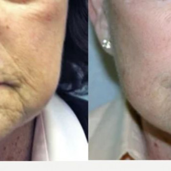 Смас ліфтинг щоки
                    Косметологічний центр Safe Cosmo Kyiv Київ