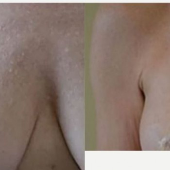 Смас ліфтинг декольте
                    Косметологический центр Safe Cosmo Kyiv Киев