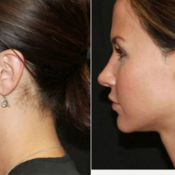 Смас ліфтинг підборіддя
                    Косметологический центр Safe Cosmo Kyiv Киев