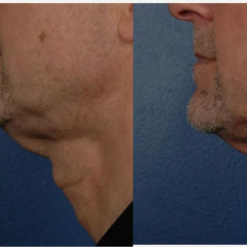 Смас ліфтинг підборіддя
                    Косметологический центр Safe Cosmo Kyiv Киев