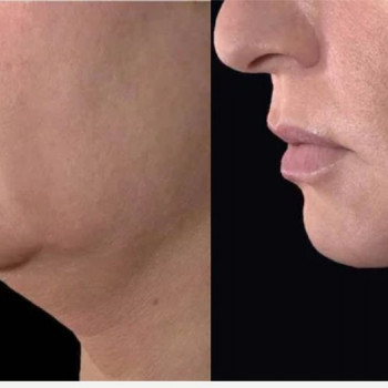 Смас ліфтинг підборіддя
                    Косметологический центр Safe Cosmo Kyiv Киев