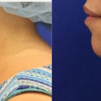 Смас ліфтинг підборіддя
                    Косметологический центр Safe Cosmo Kyiv Киев