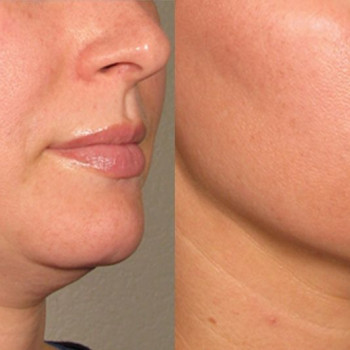 Смас ліфтинг підборіддя
                    Косметологический центр Safe Cosmo Kyiv Киев