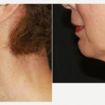 Смас ліфтинг підборіддя
                    Косметологический центр Safe Cosmo Kyiv Киев