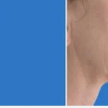 Смас ліфтинг підборіддя
                    Косметологический центр Safe Cosmo Kyiv Киев