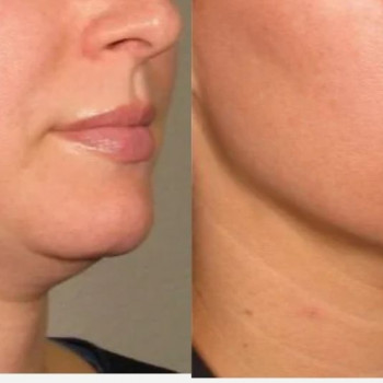 Смас ліфтинг підборіддя
                    Косметологический центр Safe Cosmo Kyiv Киев