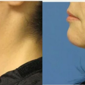 Смас ліфтинг підборіддя
                    Косметологический центр Safe Cosmo Kyiv Киев