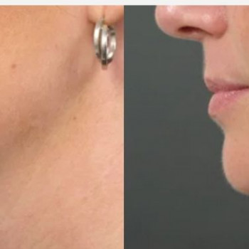 Смас ліфтинг підборіддя
                    Косметологический центр Safe Cosmo Kyiv Киев