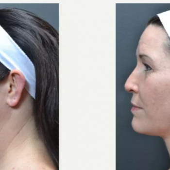 Смас ліфтинг нижньої половини обличчя
                    Косметологический центр Safe Cosmo Kyiv Киев