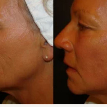 Смас ліфтинг нижньої половини обличчя
                    Косметологический центр Safe Cosmo Kyiv Киев