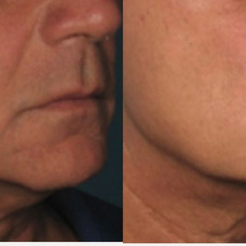 Смас ліфтинг нижньої половини обличчя
                    Косметологический центр Safe Cosmo Kyiv Киев