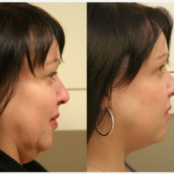 Смас ліфтинг нижньої половини обличчя
                    Косметологический центр Safe Cosmo Kyiv Киев