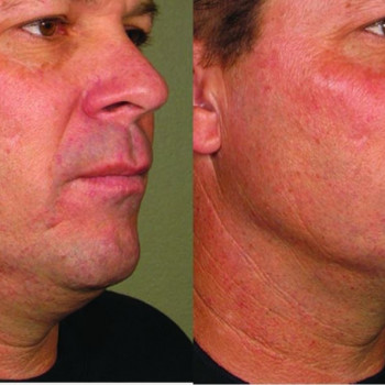 Смас ліфтинг нижньої половини обличчя
                    Косметологический центр Safe Cosmo Kyiv Киев