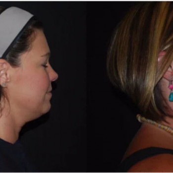 Смас ліфтинг нижньої половини обличчя
                    Косметологический центр Safe Cosmo Kyiv Киев