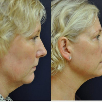 Смас ліфтинг обличчя (повністю)
                    Косметологічний центр Safe Cosmo Kyiv Київ