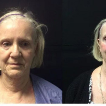 Смас ліфтинг обличчя (повністю)
                    Косметологічний центр Safe Cosmo Kyiv Київ