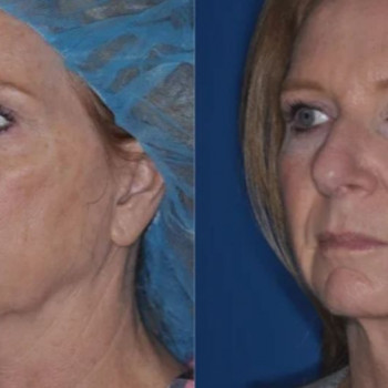 Смас ліфтинг обличчя (повністю)
                    Косметологічний центр Safe Cosmo Kyiv Київ