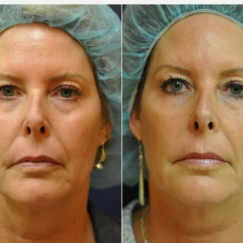 Смас ліфтинг обличчя (повністю)
                    Косметологічний центр Safe Cosmo Kyiv Київ