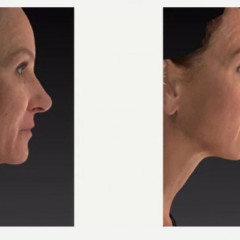 Смас ліфтинг обличчя (повністю)
                    Косметологічний центр Safe Cosmo Kyiv Київ