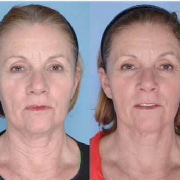 Смас ліфтинг обличчя (повністю)
                    Косметологічний центр Safe Cosmo Kyiv Київ