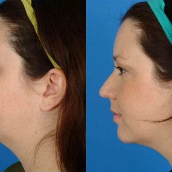 Смас ліфтинг обличчя (повністю)
                    Косметологічний центр Safe Cosmo Kyiv Київ