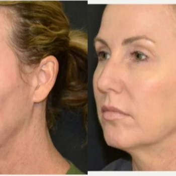 Смас ліфтинг обличчя (повністю)
                    Косметологічний центр Safe Cosmo Kyiv Київ