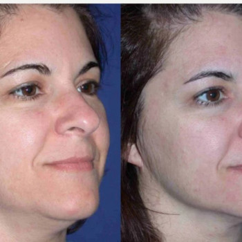 Смас ліфтинг обличчя (повністю)
                    Косметологічний центр Safe Cosmo Kyiv Київ