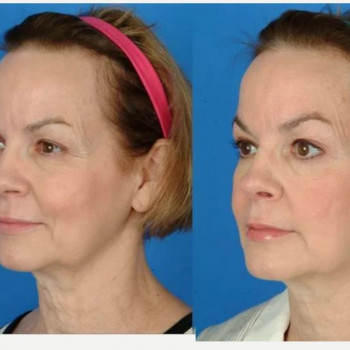 Смас ліфтинг обличчя (повністю)
                    Косметологічний центр Safe Cosmo Kyiv Київ