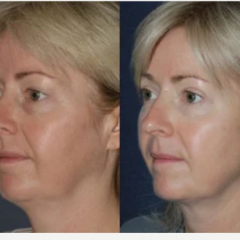 Смас ліфтинг обличчя (повністю)
                    Косметологічний центр Safe Cosmo Kyiv Київ