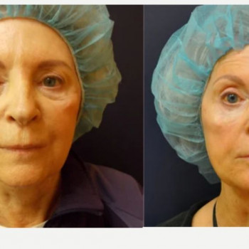 Смас ліфтинг обличчя (повністю)
                    Косметологічний центр Safe Cosmo Kyiv Київ