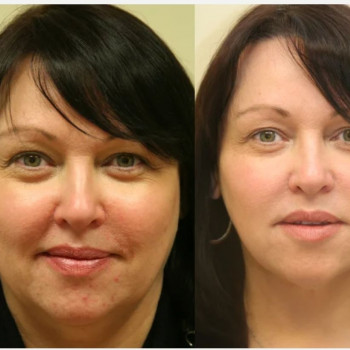 Смас ліфтинг обличчя (повністю)
                    Косметологічний центр Safe Cosmo Kyiv Київ