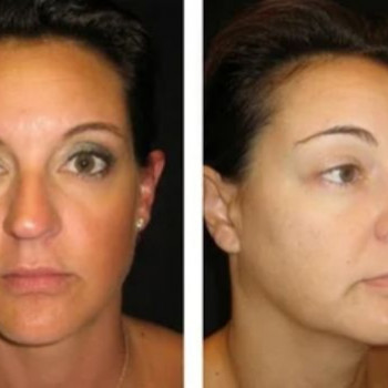 Смас ліфтинг обличчя (повністю)
                    Косметологічний центр Safe Cosmo Kyiv Київ