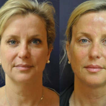 Смас ліфтинг обличчя (повністю)
                    Косметологічний центр Safe Cosmo Kyiv Київ