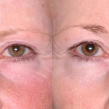 Смас ліфтинг верхньої половини обличчя
                    Косметологический центр Safe Cosmo Kyiv Киев