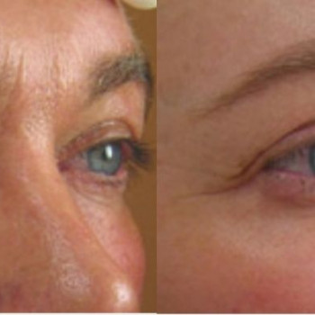 Смас ліфтинг верхньої половини обличчя
                    Косметологический центр Safe Cosmo Kyiv Киев