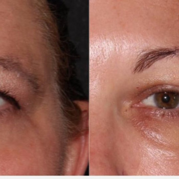 Смас ліфтинг верхньої половини обличчя
                    Косметологический центр Safe Cosmo Kyiv Киев