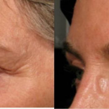 Смас ліфтинг верхньої половини обличчя
                    Косметологический центр Safe Cosmo Kyiv Киев