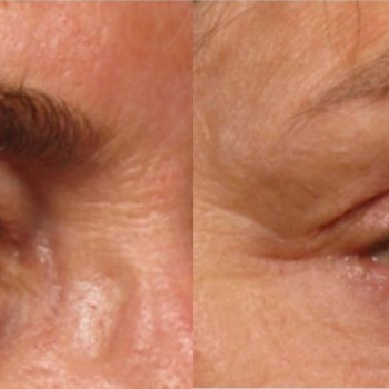 Смас ліфтинг верхньої половини обличчя
                    Косметологический центр Safe Cosmo Kyiv Киев