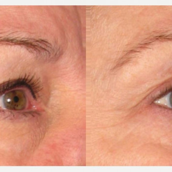 Смас ліфтинг верхньої половини обличчя
                    Косметологический центр Safe Cosmo Kyiv Киев