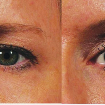 Смас ліфтинг верхньої половини обличчя
                    Косметологический центр Safe Cosmo Kyiv Киев