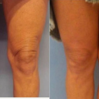 Смас ліфтинг стегон
                    Косметологічний центр Safe Cosmo Kyiv Київ