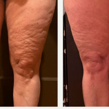 Смас ліфтинг стегон
                    Косметологічний центр Safe Cosmo Kyiv Київ