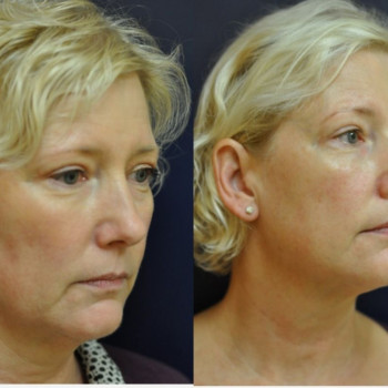 Смас ліфтинг обличчя + шия
                    Косметологічний центр Safe Cosmo Kyiv Київ