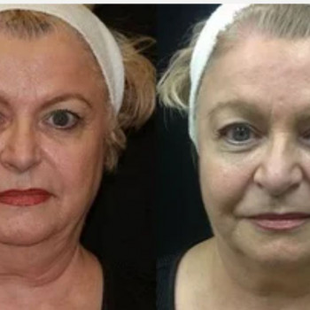 Смас ліфтинг обличчя + шия
                    Косметологічний центр Safe Cosmo Kyiv Київ