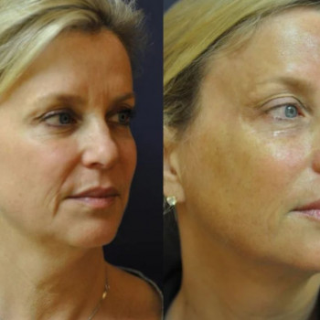 Смас ліфтинг обличчя + шия + декольте
                    Косметологический центр Safe Cosmo Kyiv Киев