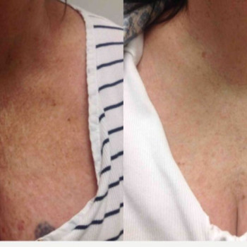 Смас ліфтинг обличчя + шия + декольте
                    Косметологический центр Safe Cosmo Kyiv Киев