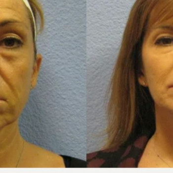 Смас ліфтинг обличчя + шия + декольте
                    Косметологический центр Safe Cosmo Kyiv Киев